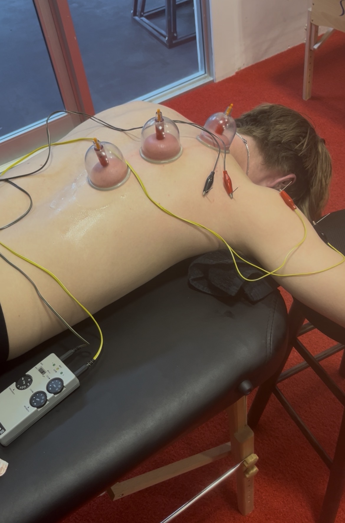 Cupping therapy treatment